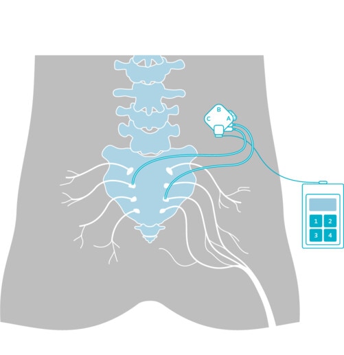 Illustrasjonsbilde av elektrode som er koblet til en pulssimulator og festet til nerver