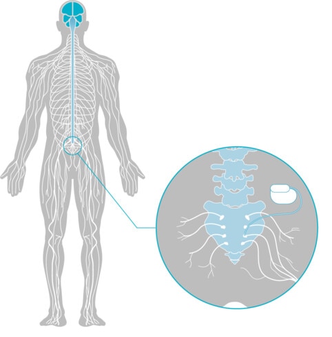 Illustrasjonsbilde av en elektrode som er plassert ved halebenet og nervesignaler som går til hjernen