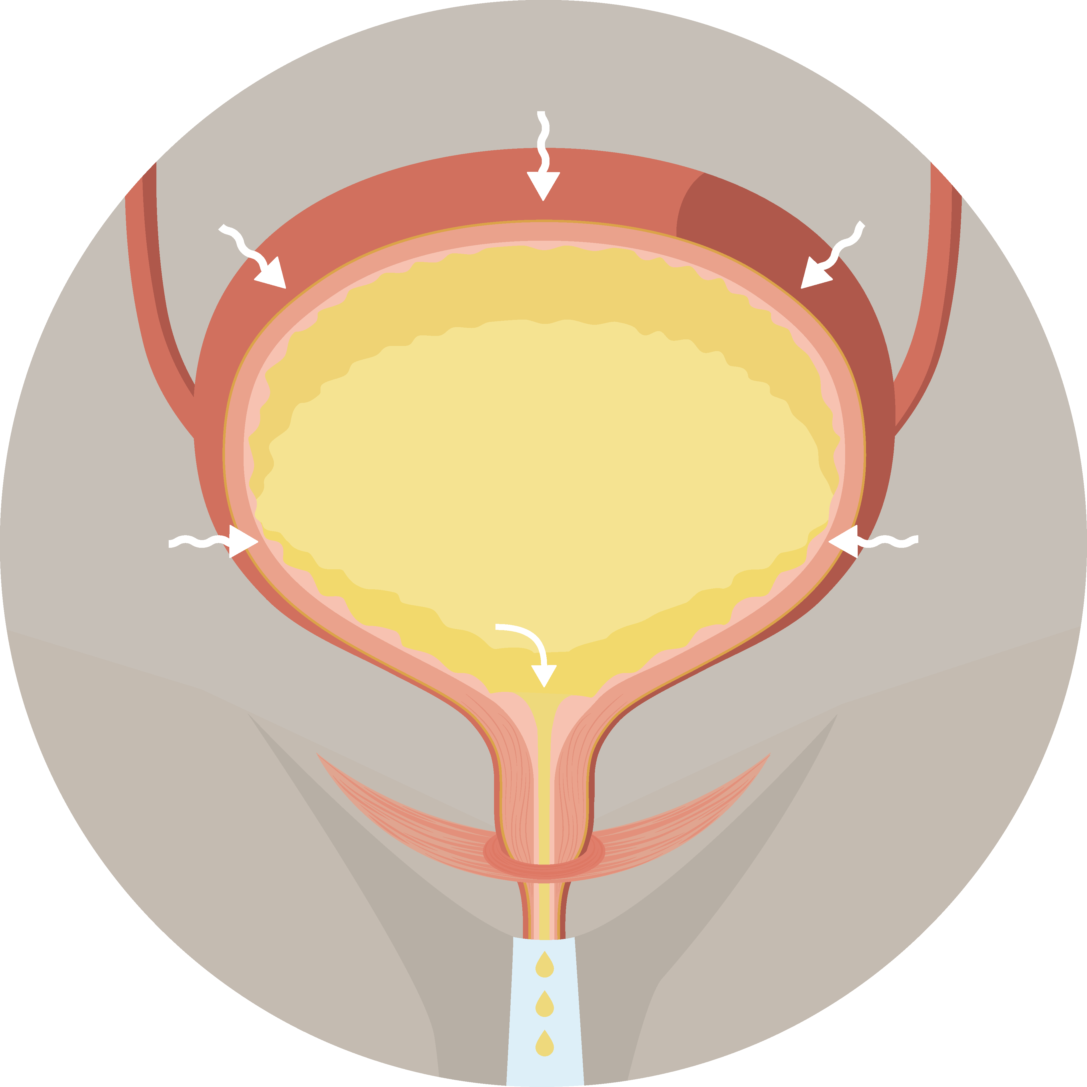 Illustrasjonsbilde av full overaktiv blære som drypper urin