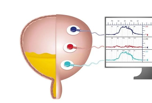 Illustrasjonsbilde av elektroder på en blære som måler aktivitet
